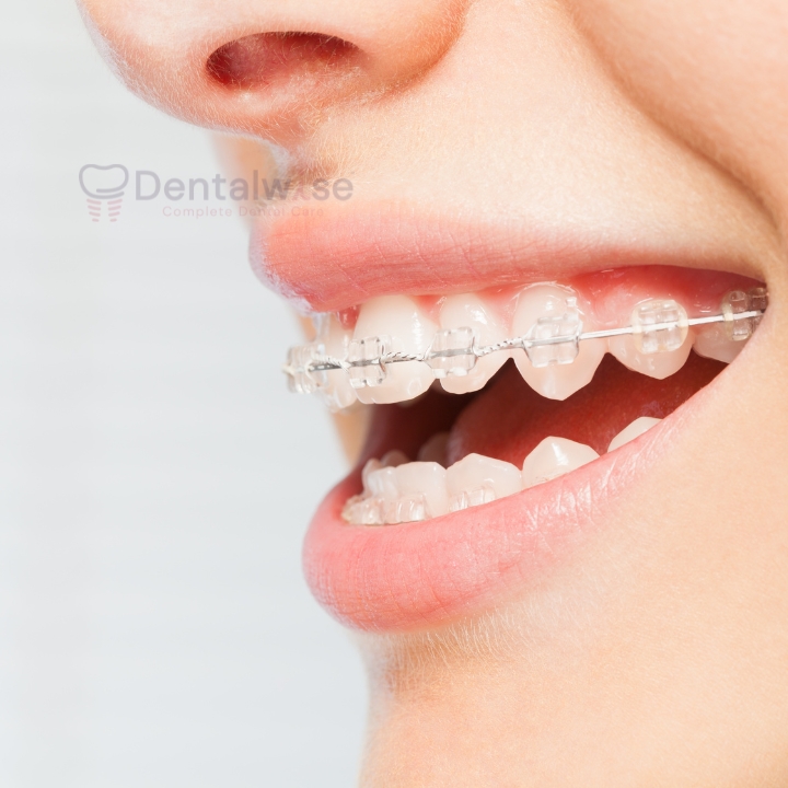 Damon braces