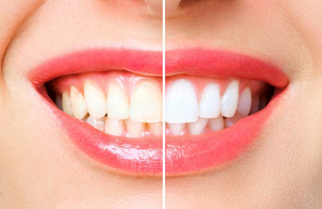Tooth-Coloured Restorations