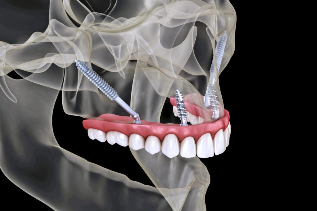 Zygoma Implants