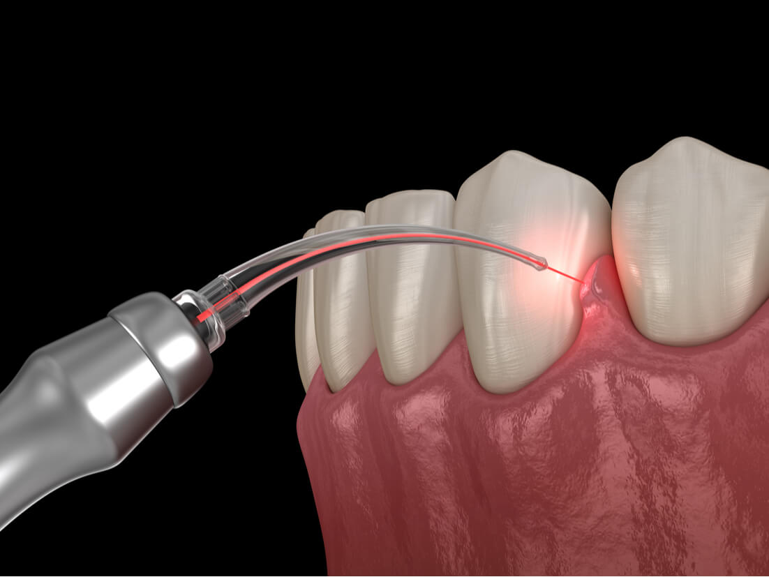 Advanced Laser Assisted RCT